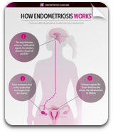 How Endometriosis Works Flashcard